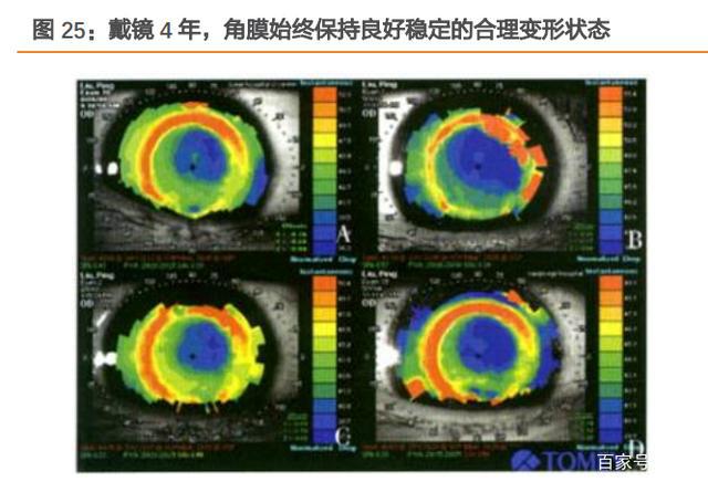 跨越视界，最新圆锥角膜治疗引领光明未来