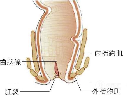 最新痔疮治疗技术探讨，观点阐述与解析，引领12月治疗新趋势